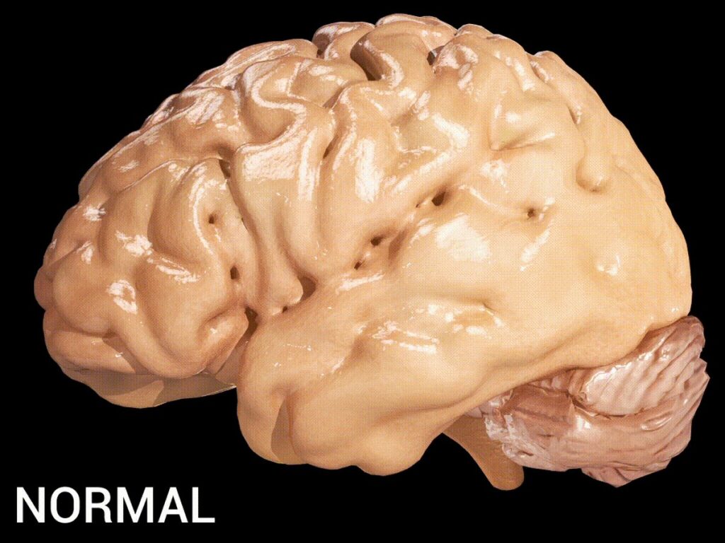 Alzheimer's Disease